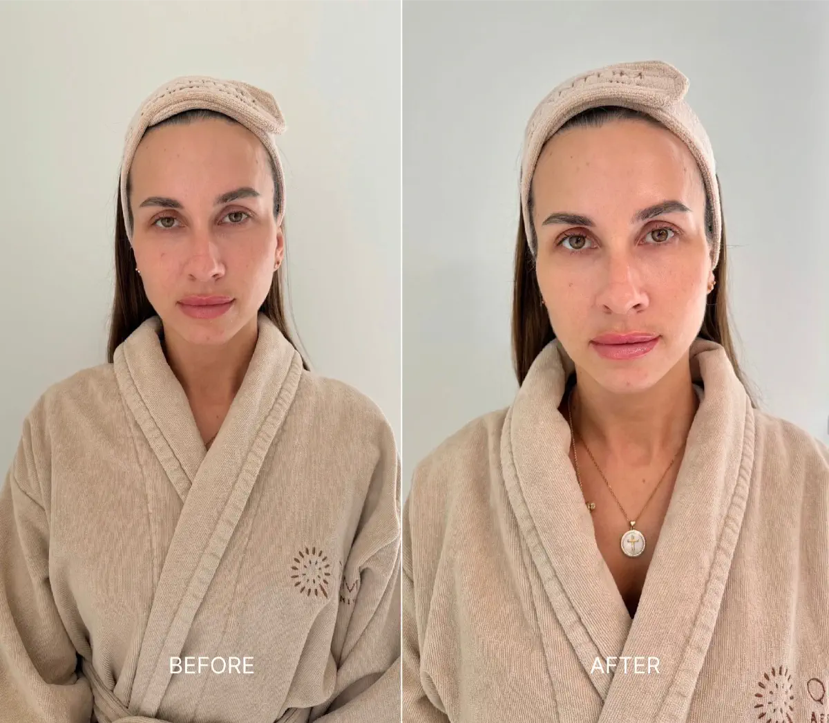 Before and after result of dermal filler treatment